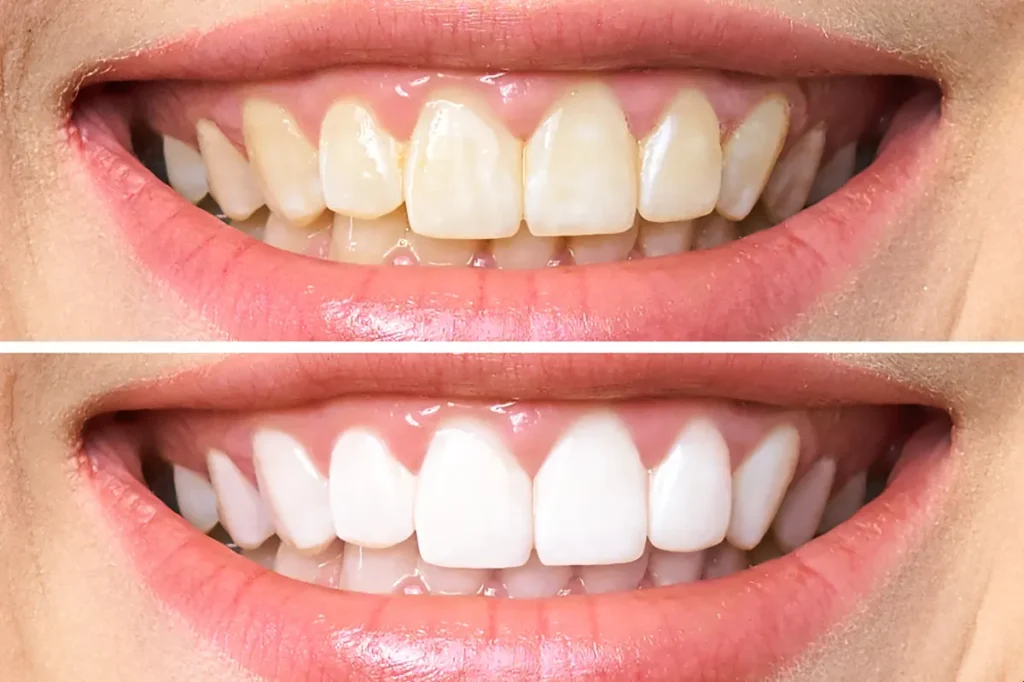 sbiancamento denti firenze